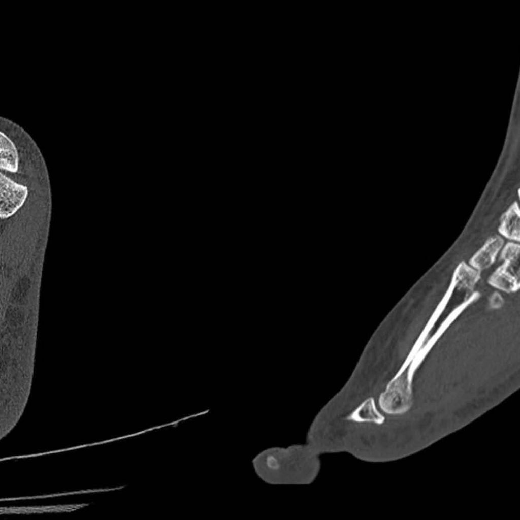 behandlungskonzept-der-lisfranc-gelenksverletzungen-orthop-die